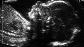 Photo prise en février 2001 d'une échographie d'un foetus, environ cinq mois après la conception. 