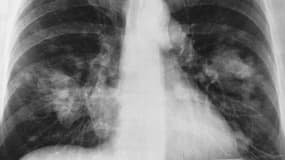 Radiographie du thorax montrant un cancer probable du poumon (taches claires à droite de chacun des poumons).