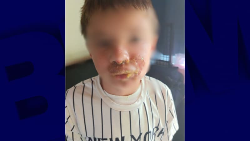 Une mère porte plainte après les graves brûlures causées à son fils de 8 ans par l'explosion d'une cube anti-stress gélatineux