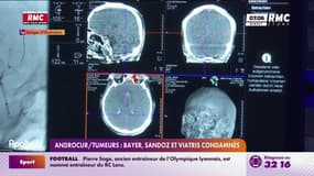Androcur: une patiente obtient la condamnation de trois laboratoires, une première en France