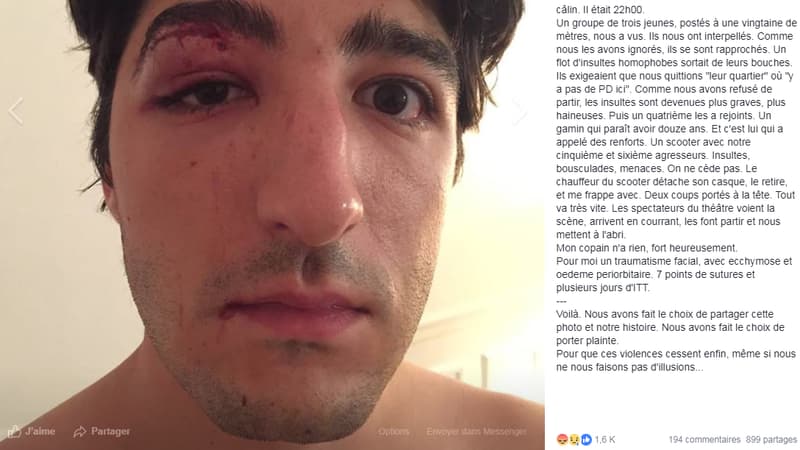Victime d'une agression homophobe, Arnaud Gagnoud écope de sept points de suture et de plusieurs jours d'ITT.