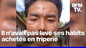 Ce tiktokteur contracte une maladie cutanée, le molluscum contagiosum, responsable des pustules sur son visage 