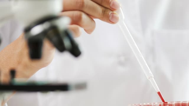 Un lymphome est un cancer du sang qui se développe dans le système lymphatique.