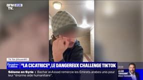 S'infliger une balafre pour s'inventer une histoire: la dangereuse tendance de "la cicatrice" sur TikTok